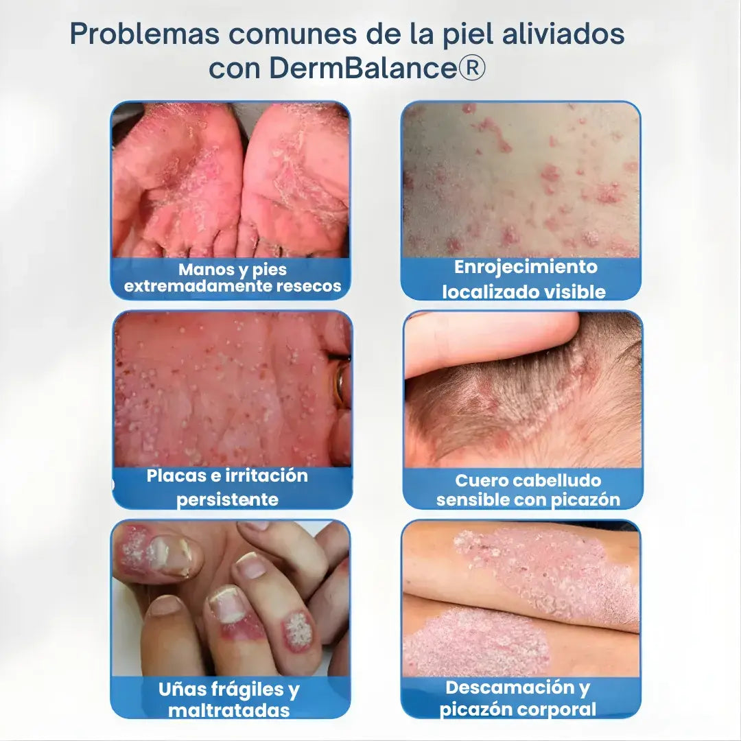 DermBalance® Crema calmante avanzada + acción anti-picazón + rápida absorción