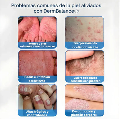 DermBalance® Crema calmante avanzada + acción anti-picazón + rápida absorción